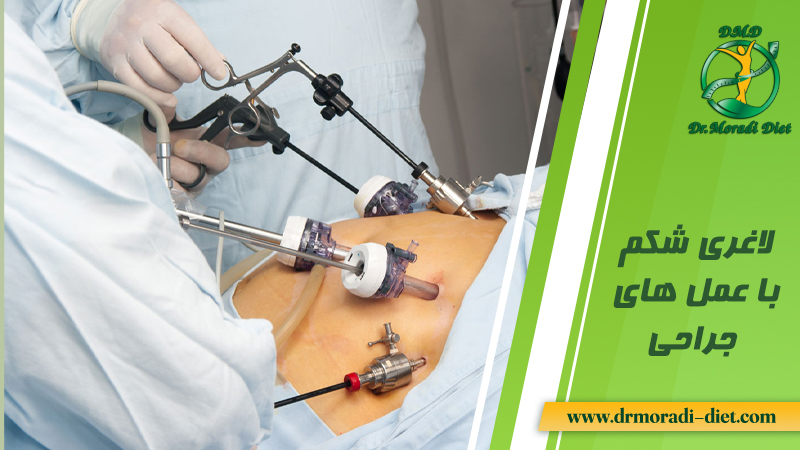 لاغری شکم با عمل جراحی تحت نظر متخصص