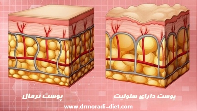 پوست نرمال و دارای سلولیت از نظر متخصص تغذیه