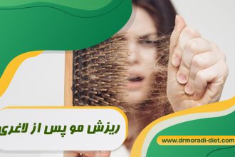 ریزش مو پس از لاغری تحت نظر متخصص تغذیه دکتر مرادی