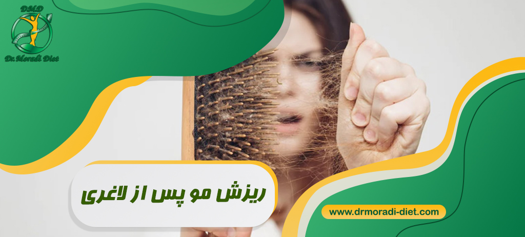 ریزش مو پس از لاغری تحت نظر متخصص تغذیه دکتر مرادی