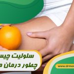 سلولیت چیست و چطور درمان می‌شود؟ با مشورت متخصص تغذیه دکتر مرادی