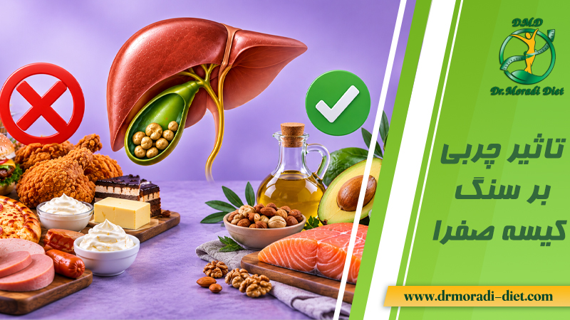 تاثیر چربی بر سنگ کیسه صفرا زیر نظر دکتر تغذیه